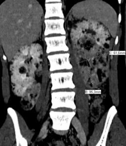 Figure 1 - Scanner initiale : mise en évidence d’un AML gauche 9,5 x 6 cm. On retrouve également de multiples lésions bilatérales de petite taille.