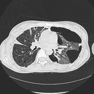 Figure 2 - Pneumothorax gauche et multiples lésions kystiques pulmonaires bilatérales (LAM).